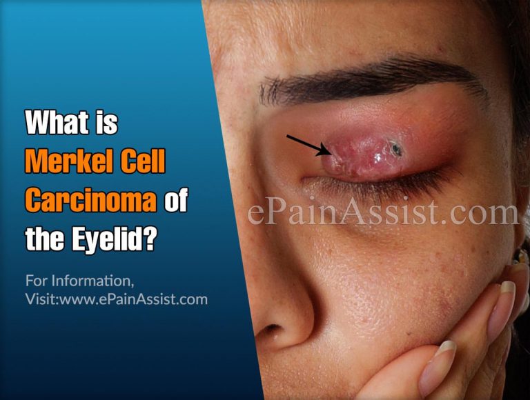 What Is Merkel Cell Carcinoma Of The Eyelid & Merkel Cell Carcinoma Of Thigh?