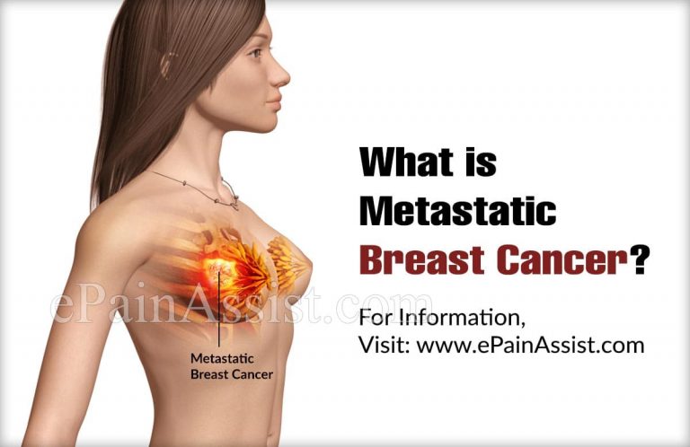 Metastatic Breast Cancer Treatment: 10 Things to Know When Starting the Treatment