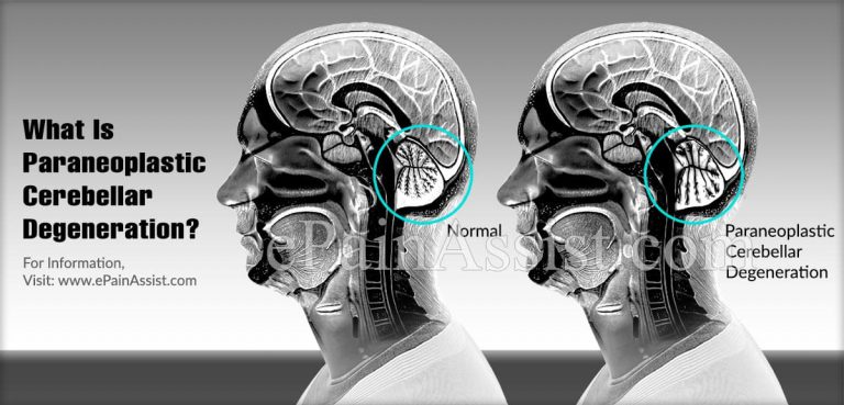 What Is Paraneoplastic Cerebellar Degeneration?