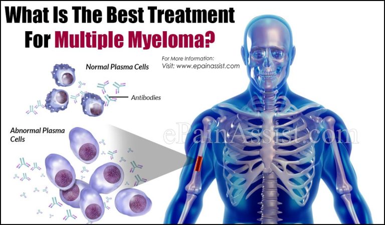 What Is The Best Treatment For Multiple Myeloma?