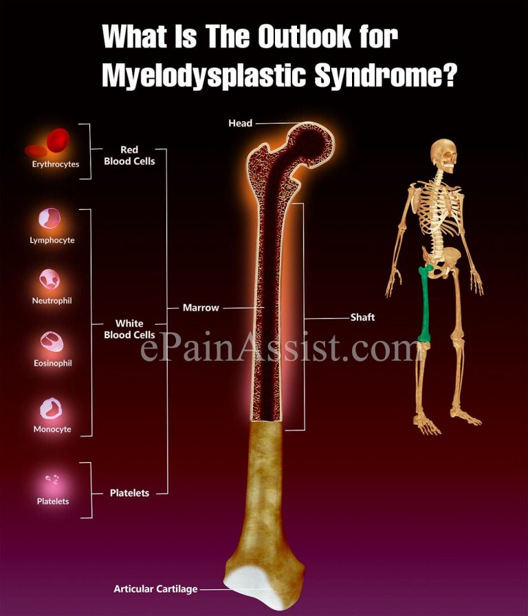 What Is The Outlook for Myelodysplastic Syndrome?