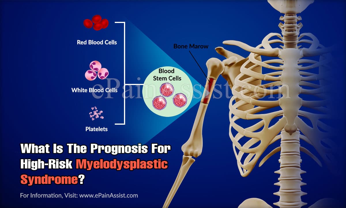 What Is The Prognosis For High-Risk Myelodysplastic Syndrome?