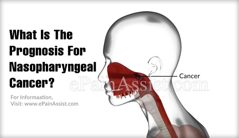 What Is The Prognosis For Nasopharyngeal Cancer?