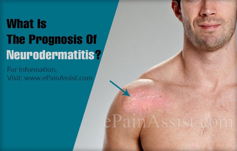 What Is The Prognosis Of Neurodermatitis?