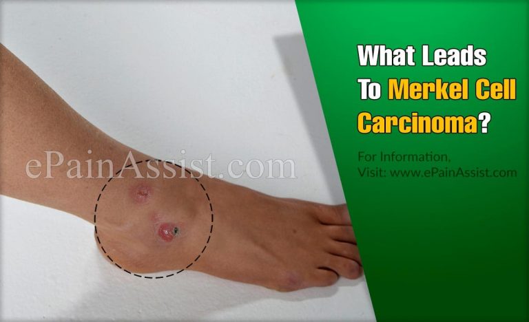 What Leads To Merkel Cell Carcinoma & Can It Be Cured?
