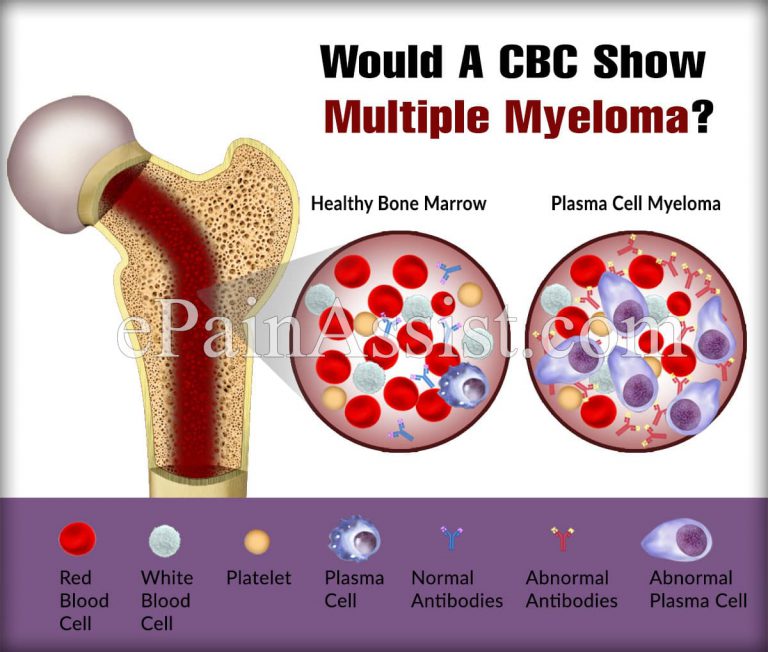 Would A CBC Show Multiple Myeloma?