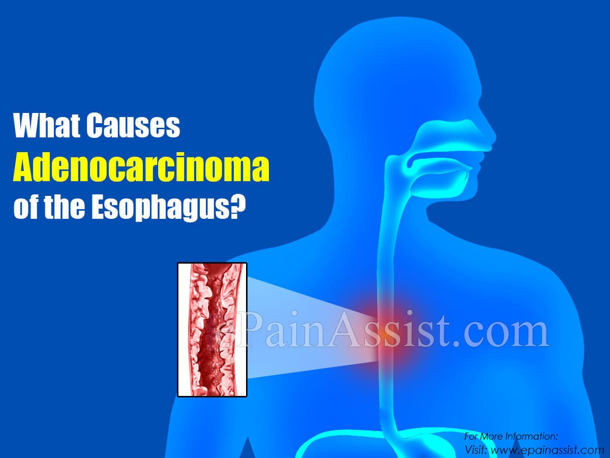 What Causes Adenocarcinoma of the Esophagus?