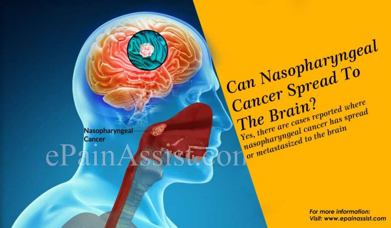 Can Nasopharyngeal Cancer Spread To The Brain?