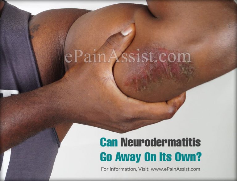 Can Neurodermatitis Go Away On Its Own & How Do I Know If I Have It?