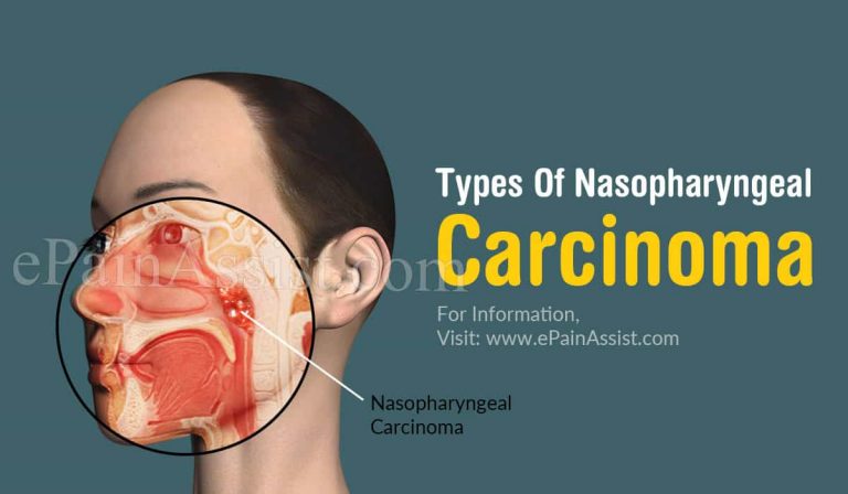 Classification/Types Of Nasopharyngeal Carcinoma