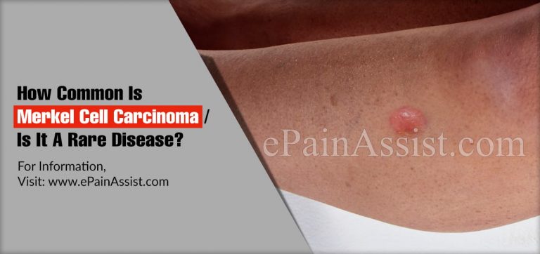 How Common Is Merkel Cell Carcinoma Or Is It A Rare Disease?