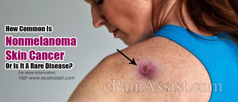 How Common Is Nonmelanoma Skin Cancer Or Is It A Rare Disease?