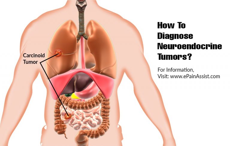 How To Diagnose Neuroendocrine Tumors & What Is The Best Medicine For It?