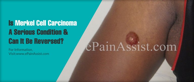 Is Merkel Cell Carcinoma A Serious Condition & Can It Be Reversed?