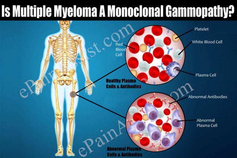 Is Multiple Myeloma A Monoclonal Gammopathy?