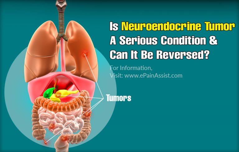 Is Neuroendocrine Tumor A Serious Condition & Can It Be Reversed?