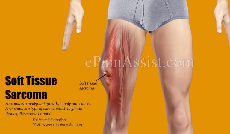 Soft Tissue Sarcoma: Stages, Symptoms, Risk Factors, Treatment, Survival Rate