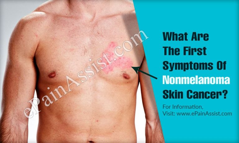 What Are The First Symptoms Of Nonmelanoma Skin Cancer & How Do You Test For It?