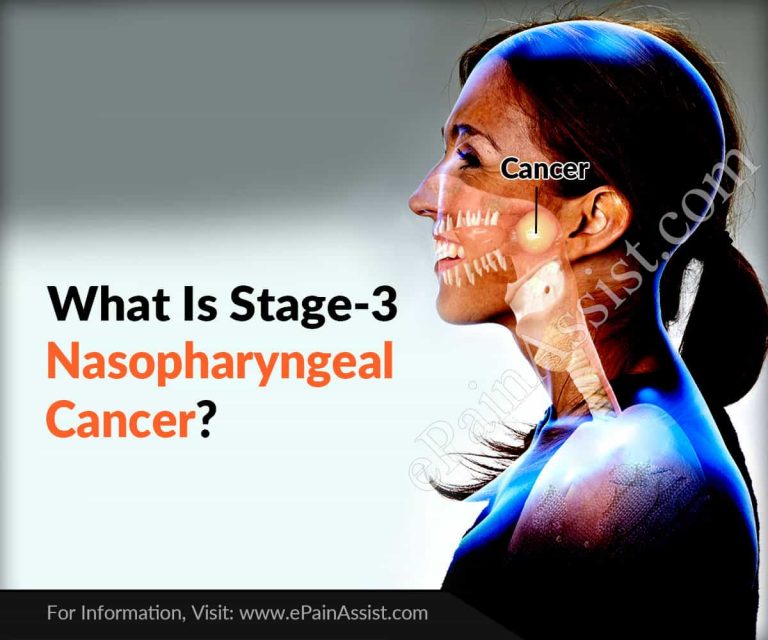 What Is Stage-3 Nasopharyngeal Cancer?
