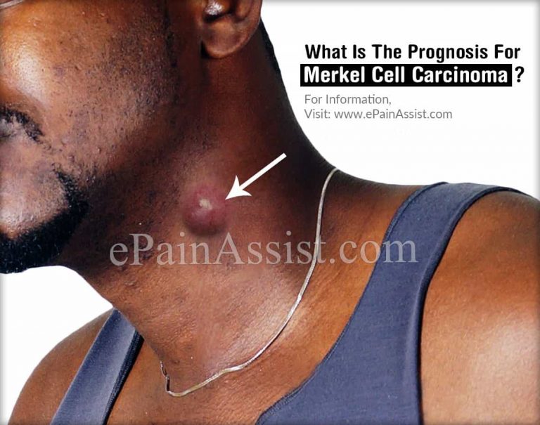 What Is The Prognosis For Merkel Cell Carcinoma?