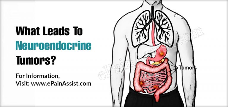 What Leads To Neuroendocrine Tumors & Can They Be Cured?
