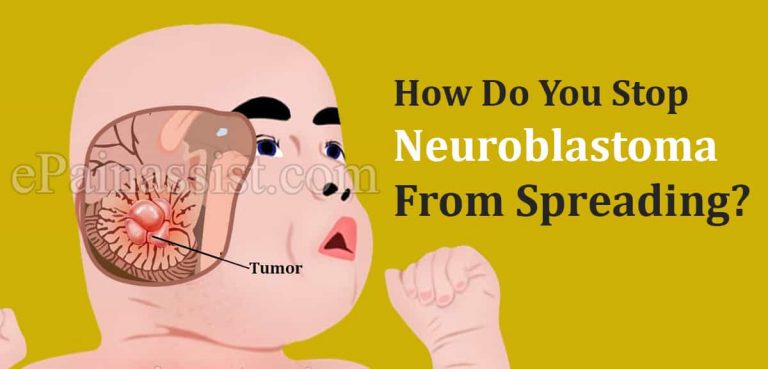 How Do You Stop Neuroblastoma From Spreading?