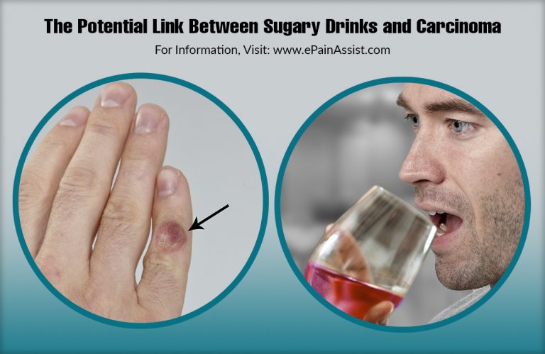 The Potential Link Between Sugary Drinks and Carcinoma