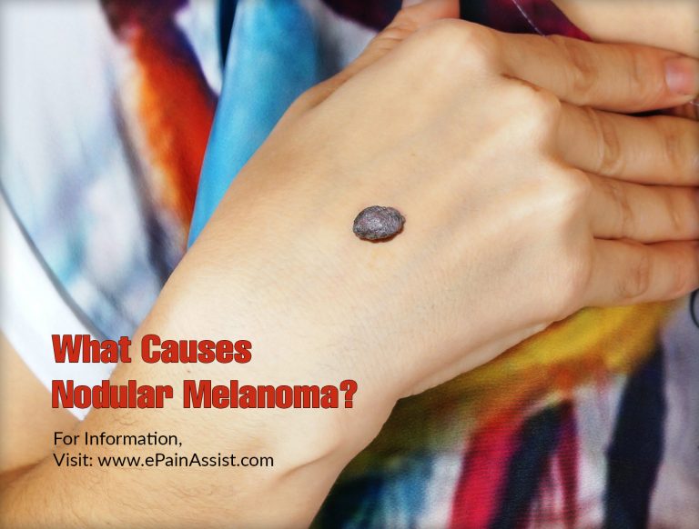 Nodular Melanoma: Causes, Symptoms, Treatment