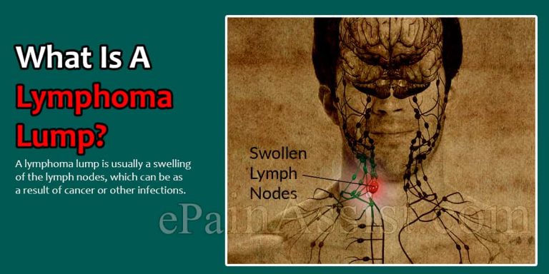 What Is A Lymphoma Lump?
