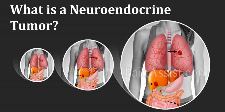 Neuroendocrine Tumors : Types, Symptoms, Causes, Risks, Treatment and Diagnosis