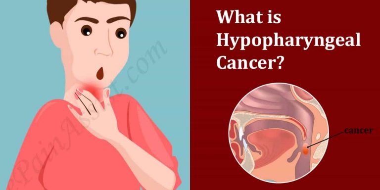 What is Hypopharyngeal Cancer: Causes, Symptoms, Treatment, Prognosis