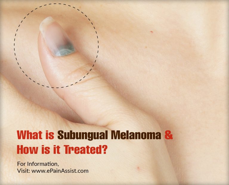 What is Subungual Melanoma & How is it Treated? | Causes and Symptoms of Subungual Melanoma