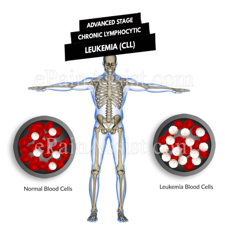 Advanced Stage Chronic Lymphocytic Leukemia (CLL) : Symptoms & Treatment