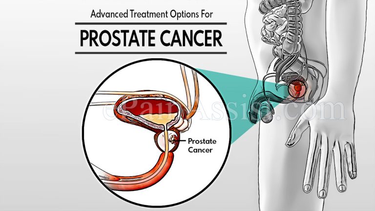 Advanced Treatment Options For Prostate Cancer