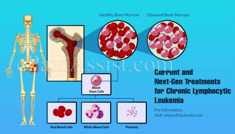 Current and Next-Gen Treatments for Chronic Lymphocytic Leukemia