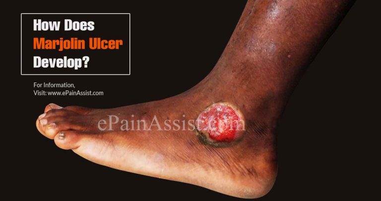 How Does Marjolin Ulcer Develop & How is it Treated?