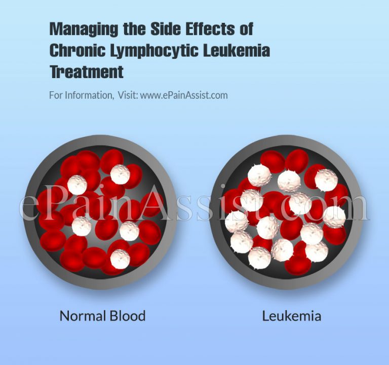 Managing the Side Effects of Chronic Lymphocytic Leukemia Treatment