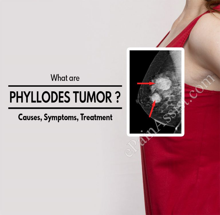 Phyllodes Tumor: Causes, Symptoms, Treatment, Diagnosis