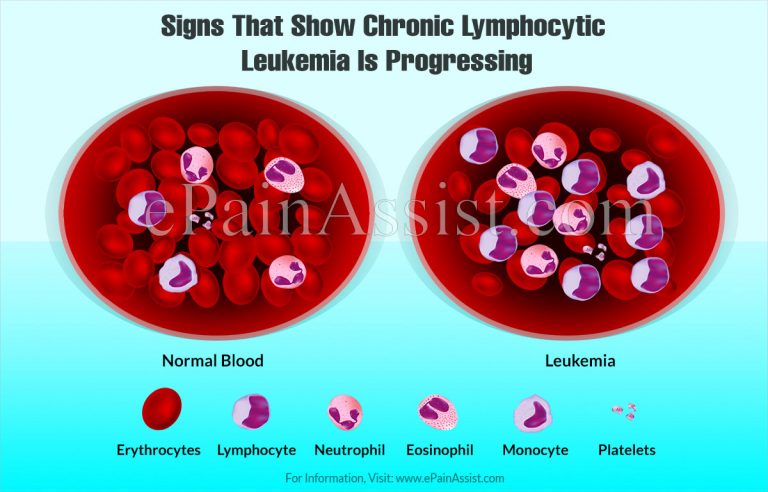 Signs That Show Chronic Lymphocytic Leukemia Is Progressing