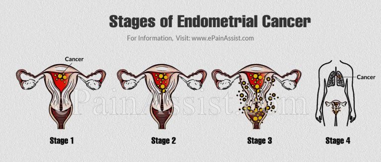 Early Warning Signs of Endometrial Cancer