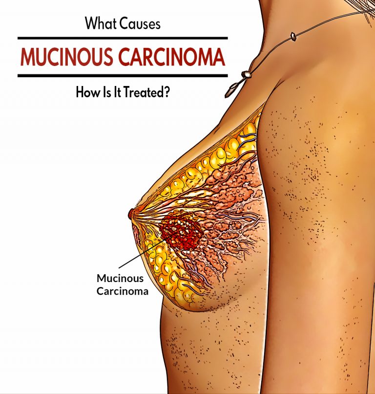 What Causes Mucinous Carcinoma & How Is It Treated?