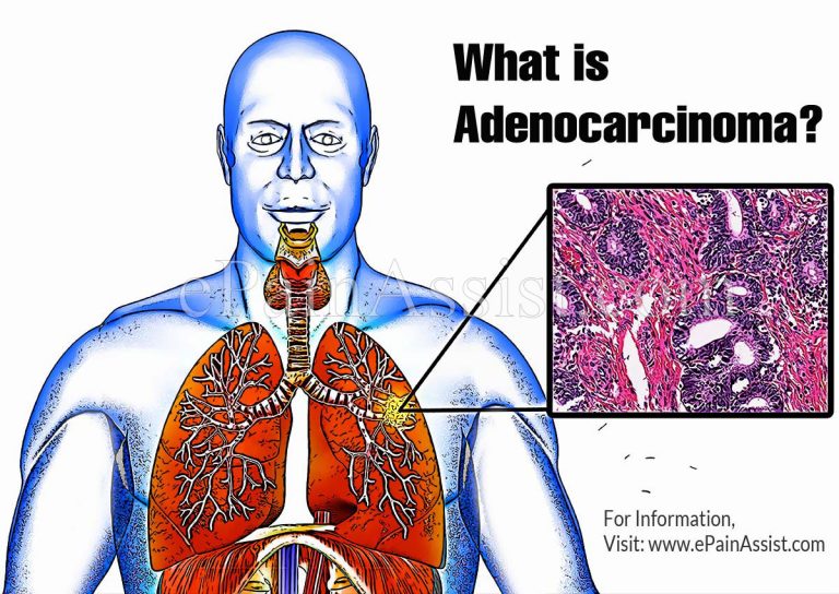 Causes & Symptoms of Adenocarcinom|How is Adenocarcinoma Treated?