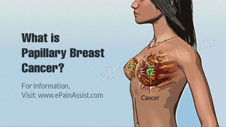 What is Papillary Breast Cancer & How is it Treated? | Causes, Symptoms, Outlook and Risk Factors of Papillary Breast Cancer