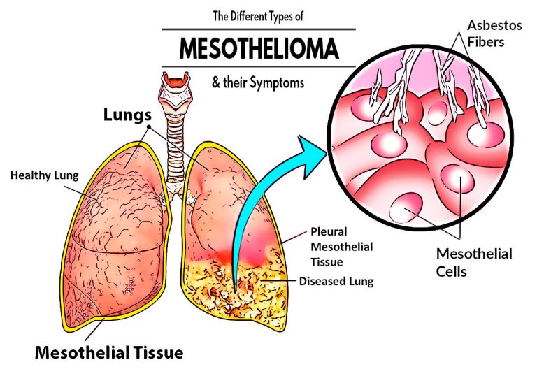 The Different Types of Mesothelioma and their Symptoms