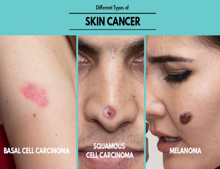 The Different Types of Skin Cancer and Risk Factors for Development