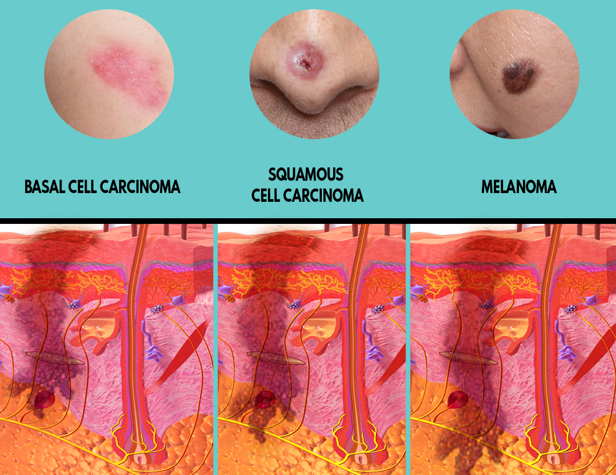 Basal cell carcinoma | Squamous cell carcinoma | Melanoma