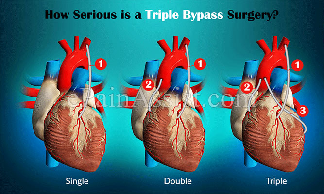 How Serious is a Triple Bypass Surgery?