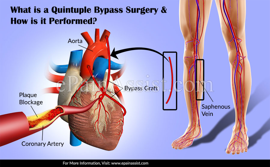 What is a Quintuple Bypass Surgery?