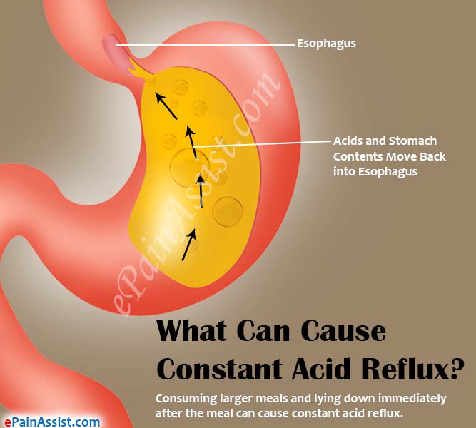 Symptoms and treatment of acid reflux