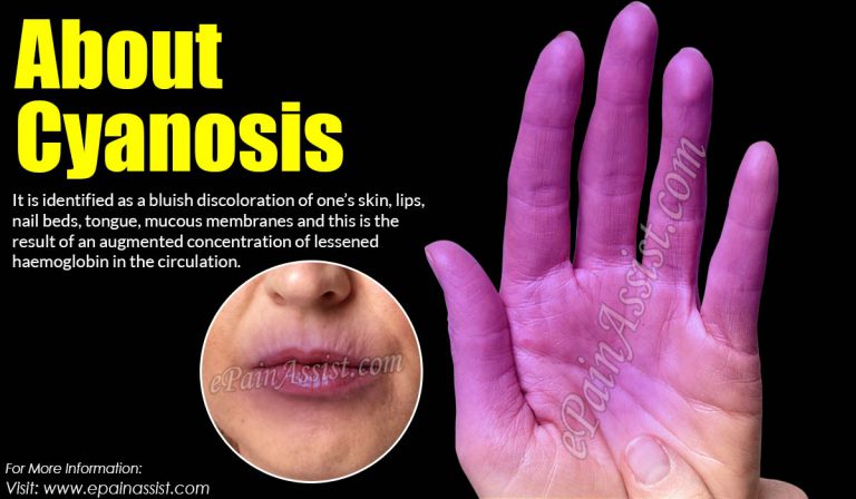 Cyanosis: Causes, Symptoms, Types, Treatment, What does it mean when your Lips are Blue?